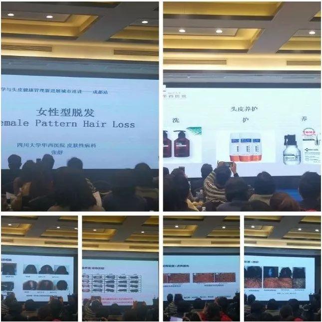 脱发最新进展，头顶奇遇与友情力量的力量探索